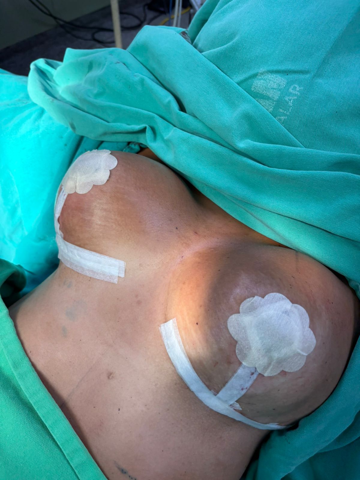 Resultado após cirurgia - Caso 6